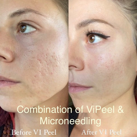 TWO Treatments! Get Either a VI Peel or Microneedling PLUS a 60-Minute Oxygen Facial at 5-Star Rated Glowrious Skin! Includes a $50 Glowrious Gift Card