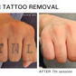 Tattoo Removal Treatments at Sante Spa in Thousand Oaks Starting at Just $48! May Purchase up to Eight Laser Treatment Sessions.