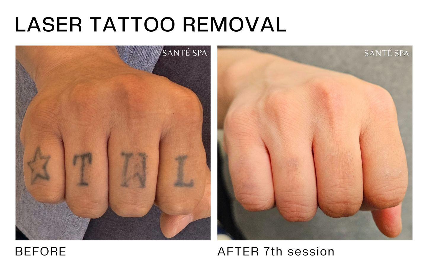 Tattoo Removal Treatments at Sante Spa in Thousand Oaks Starting at Just $48! May Purchase up to Eight Laser Treatment Sessions.
